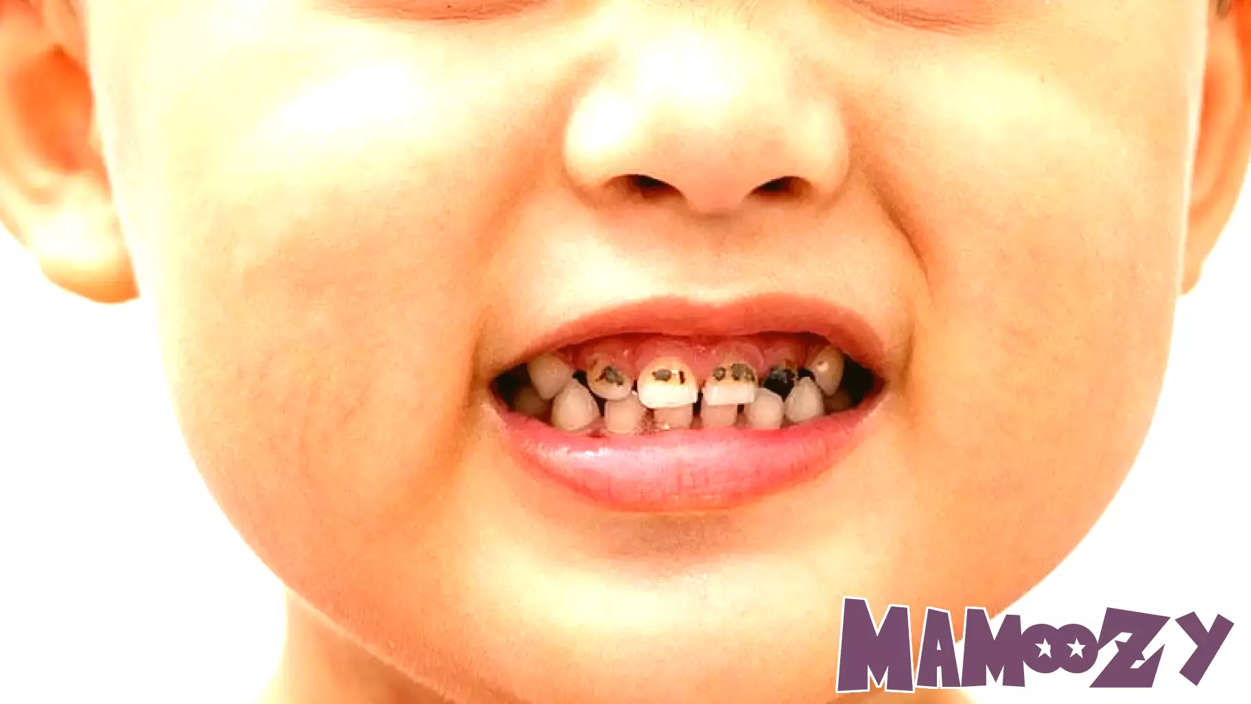 Helicopter Parenting: Risk for Tooth Decay in Children?